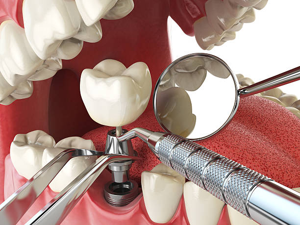 Best Emergency Root Canal Treatment in Corona, CA